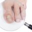 toenail exam
